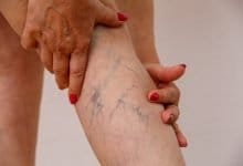 varices en las piernas