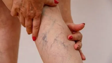 varices en las piernas