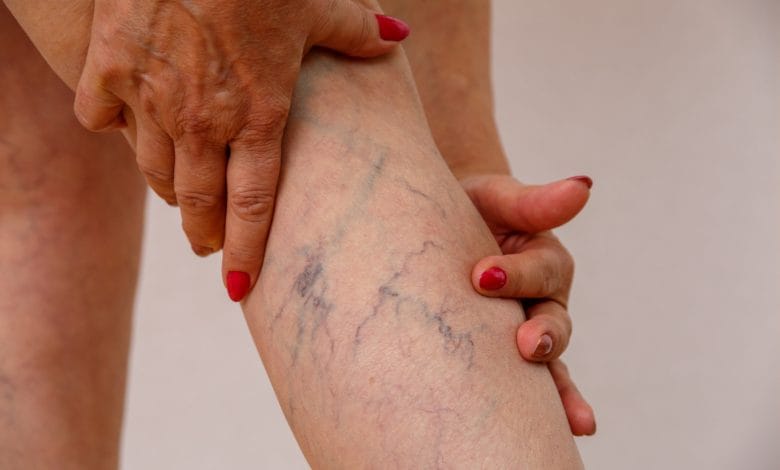 varices en las piernas