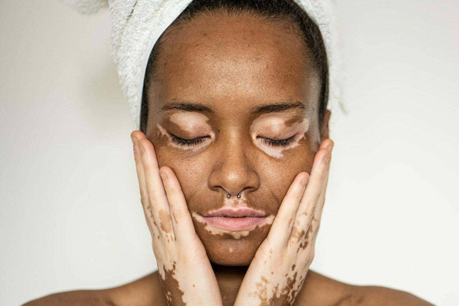 mujer morena joven con vitiligo en su cara y manos