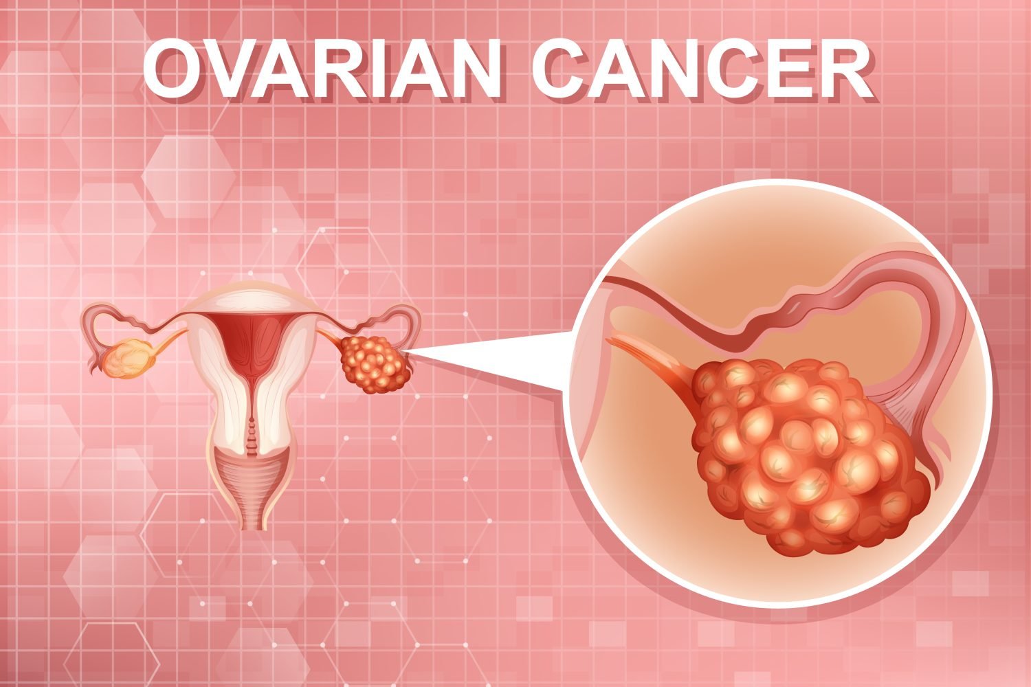 Ilustración de cáncer de ovario en un sistema reproductor femenino
