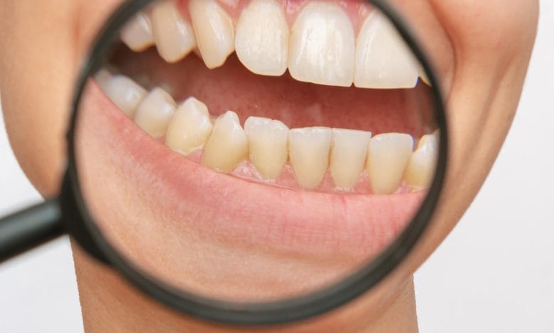 Dientes de persona con manchados de amarillo / caries / dientes amarillos / sarro dental / limón en ayunas / mal aliento