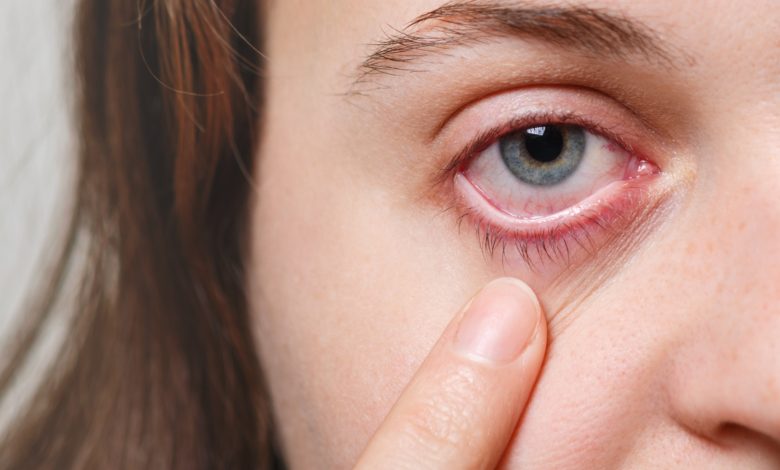 Cáncer de ojo: ¿cuáles son los signos y síntomas? / bicarbonato de sodio