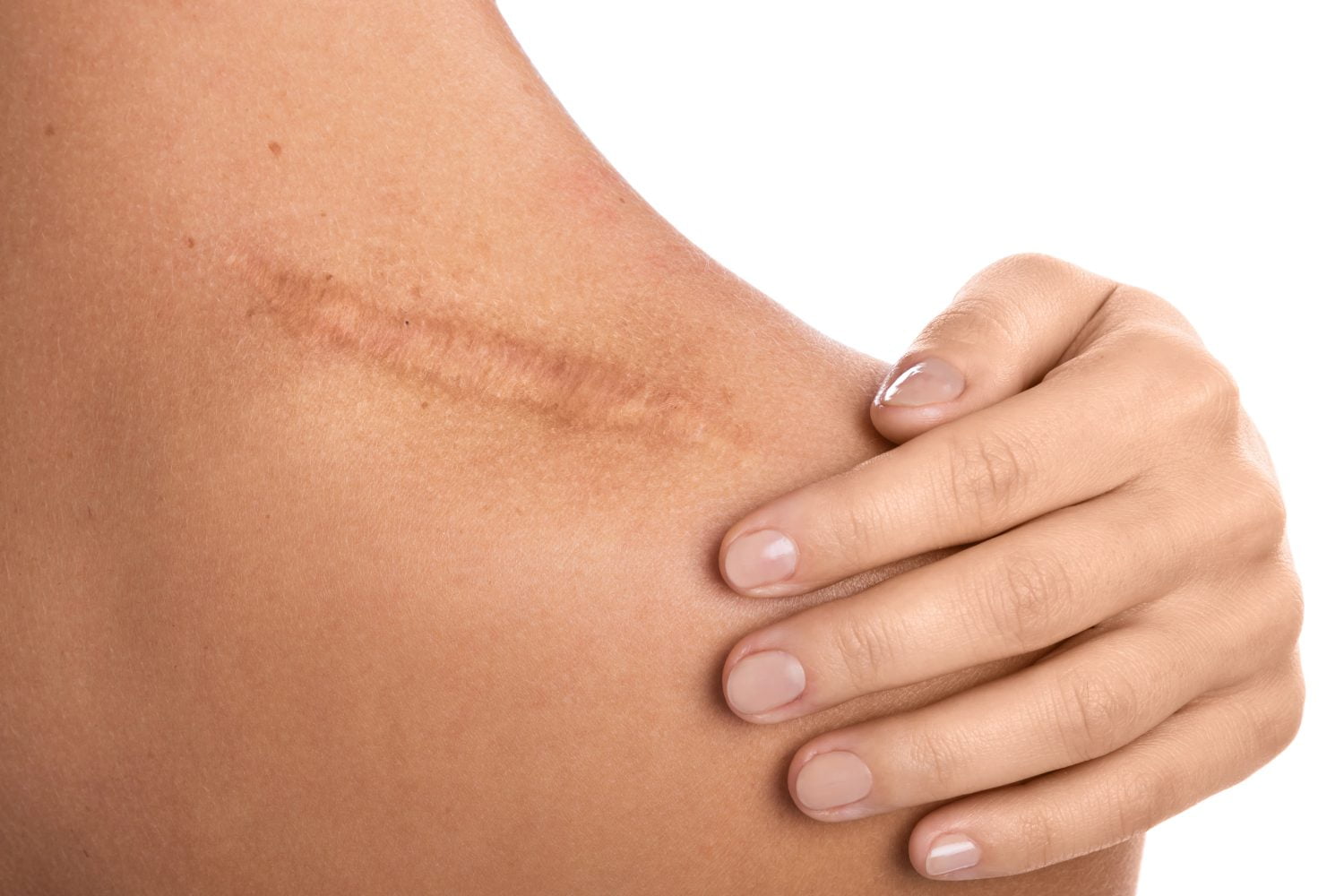 Recetas naturales eficaces para eliminar cicatrices y conservar la piel